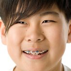 metal braces near you